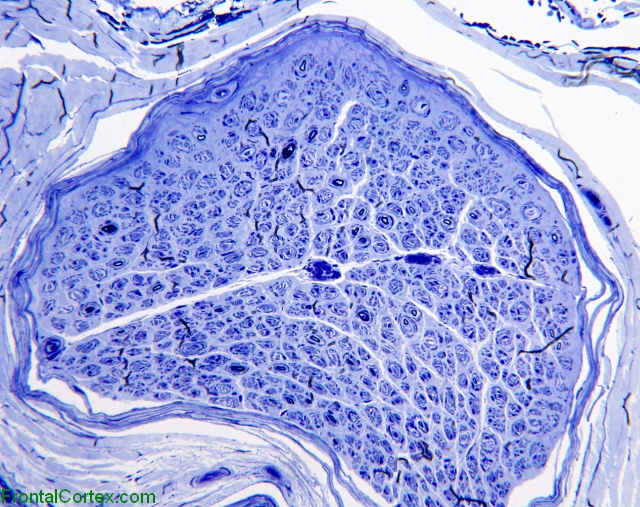 Hereditary sensory and motor neuropathy, type 1, sural nerve, toluidine blue x 200